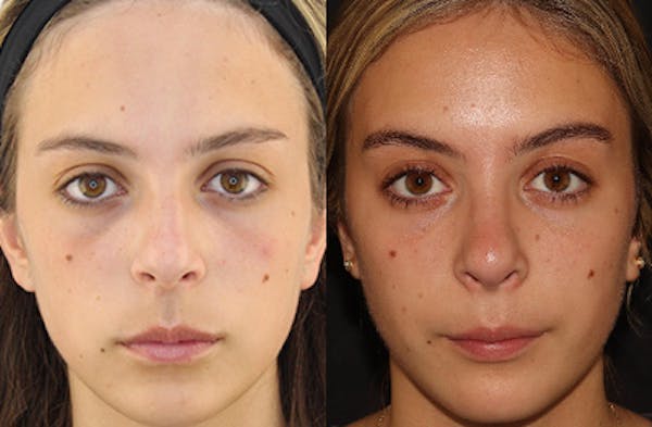 Rhinoplasty Before & After Gallery - Patient 144542039 - Image 3