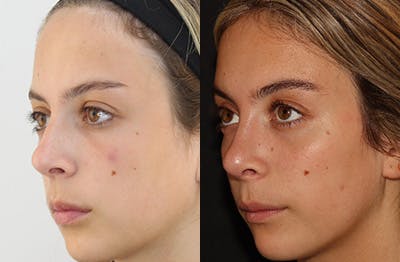 Rhinoplasty Before & After Gallery - Patient 144542039 - Image 4