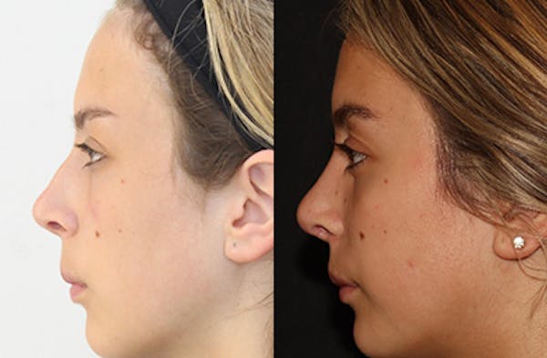 Rhinoplasty Before & After Gallery - Patient 144542039 - Image 5
