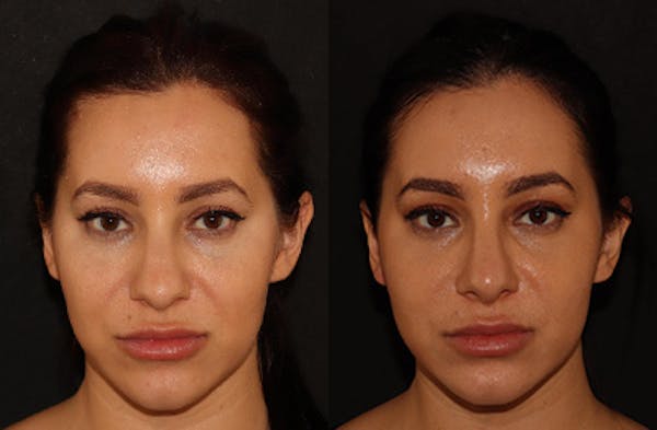 Rhinoplasty Before & After Gallery - Patient 146150762 - Image 3