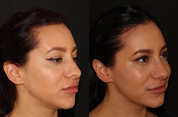 Rhinoplasty Before & After Gallery - Patient 146150762 - Image 2