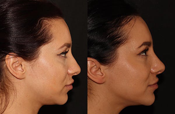 Rhinoplasty Before & After Gallery - Patient 146150762 - Image 1
