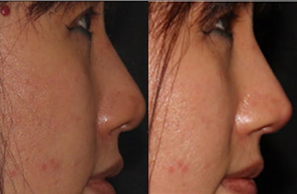 Rhinoplasty Before & After Gallery - Patient 54185045 - Image 1