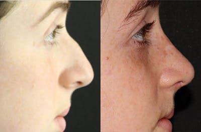 Rhinoplasty Before & After Gallery - Patient 54185047 - Image 1