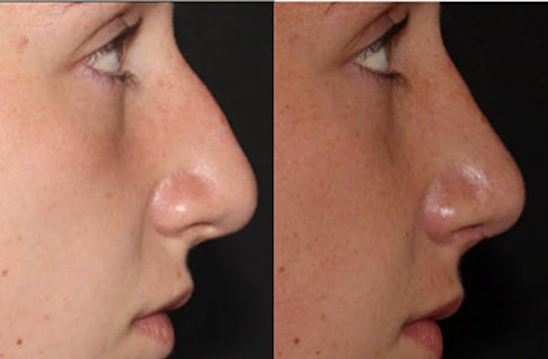 Rhinoplasty Before & After Gallery - Patient 54185044 - Image 1