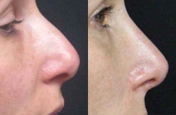 Rhinoplasty Before & After Gallery - Patient 54185048 - Image 1