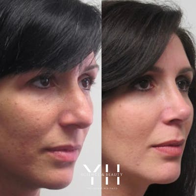 Rhinoplasty Before & After Gallery - Patient 148163720 - Image 1