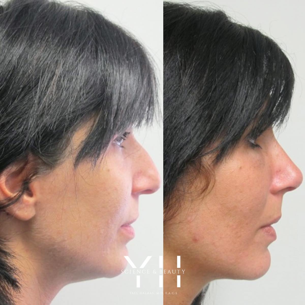 Rhinoplasty Before & After Gallery - Patient 148163720 - Image 2