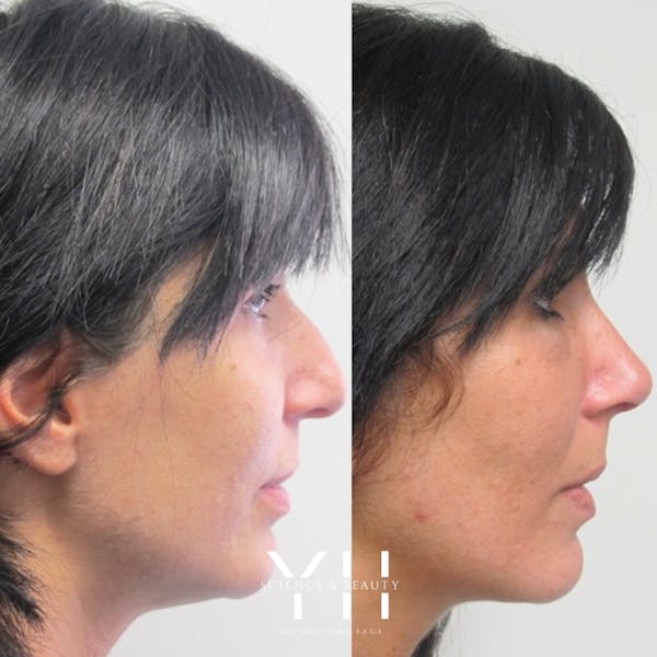 Chin Filler Before & After Gallery - Patient 148163723 - Image 2