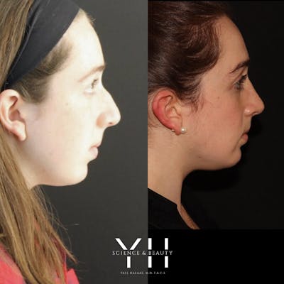 Rhinoplasty Before & After Gallery - Patient 148163719 - Image 2