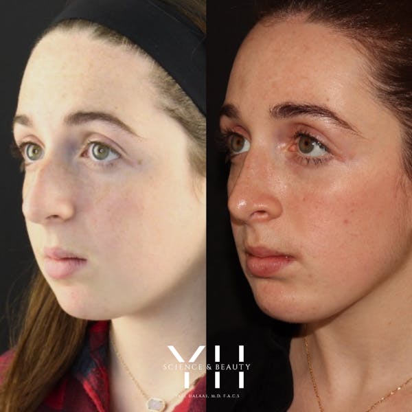 Rhinoplasty Before & After Gallery - Patient 148163719 - Image 1