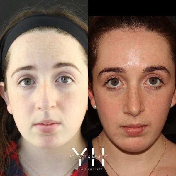 Rhinoplasty Before & After Gallery - Patient 148163719 - Image 3