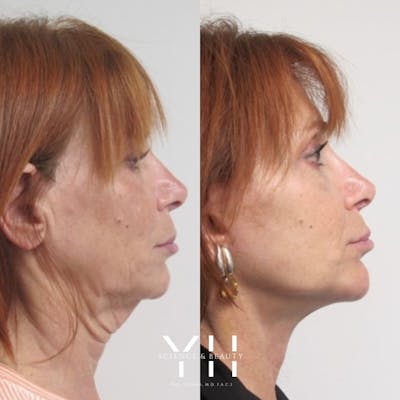 Chin Filler Before & After Gallery - Patient 148163724 - Image 1