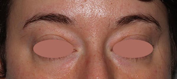 Eyebrow Transplant Before & After Gallery - Patient 148498839 - Image 1