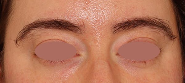 Eyebrow Transplant Before & After Gallery - Patient 148498839 - Image 2