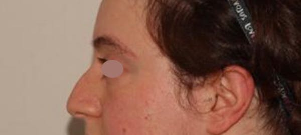 Eyebrow Transplant Before & After Gallery - Patient 148498839 - Image 3