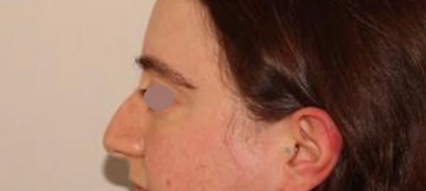 Eyebrow Transplant Before & After Gallery - Patient 148498839 - Image 4