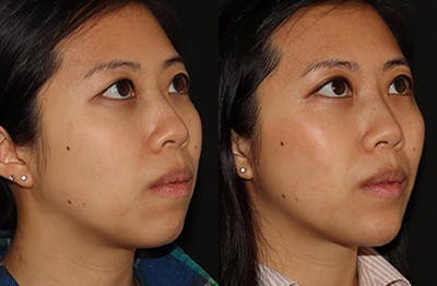 Chin Augmentation Before & After Gallery - Patient 149051072 - Image 2