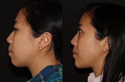 Chin Augmentation Before & After Gallery - Patient 149051072 - Image 1