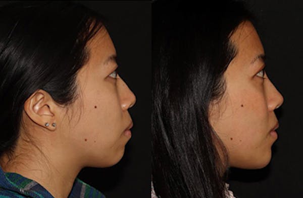Chin Augmentation Before & After Gallery - Patient 149051072 - Image 3
