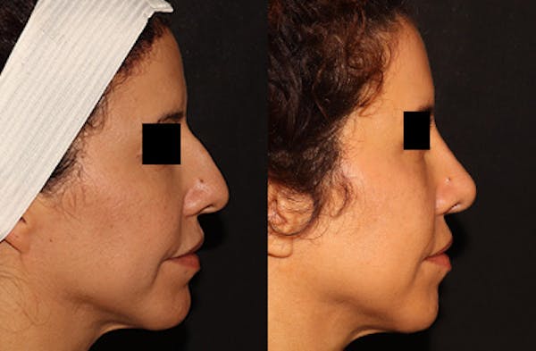 Rhinoplasty Before & After Gallery - Patient 152131462 - Image 1