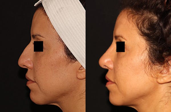 Rhinoplasty Before & After Gallery - Patient 152131462 - Image 2