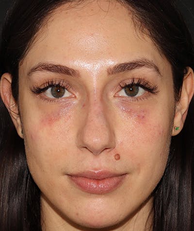 Liquid Rhinoplasty Before & After Gallery - Patient 157171660 - Image 3