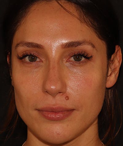 Liquid Rhinoplasty Before & After Gallery - Patient 157171660 - Image 4