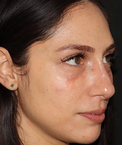 Liquid Rhinoplasty Before & After Gallery - Patient 157171660 - Image 5