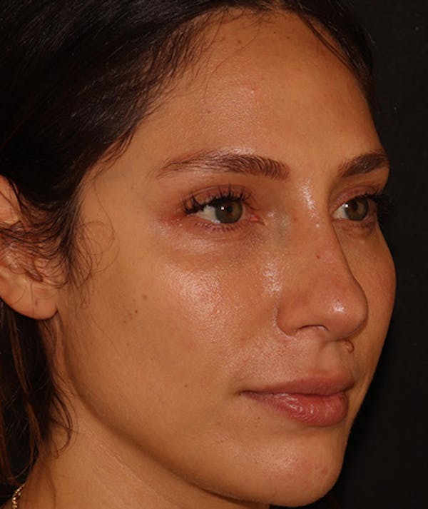 Liquid Rhinoplasty Before & After Gallery - Patient 157171660 - Image 6