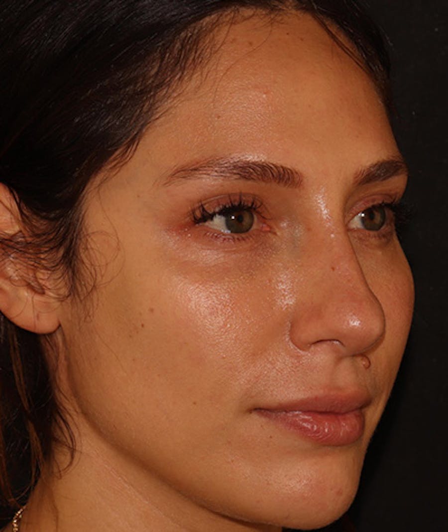 Liquid Rhinoplasty Before & After Gallery - Patient 157171660 - Image 6