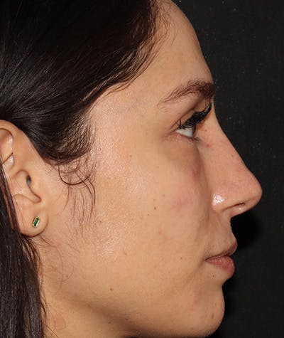 Liquid Rhinoplasty Before & After Gallery - Patient 157171660 - Image 7