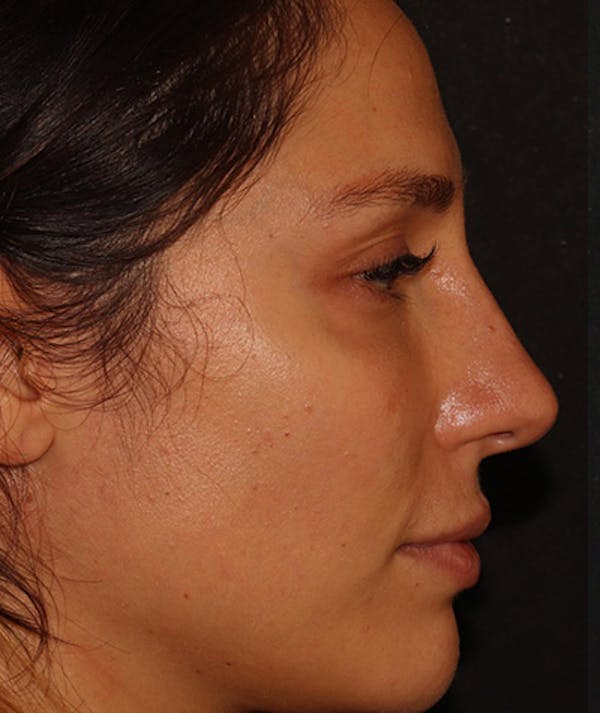 Liquid Rhinoplasty Before & After Gallery - Patient 157171660 - Image 8