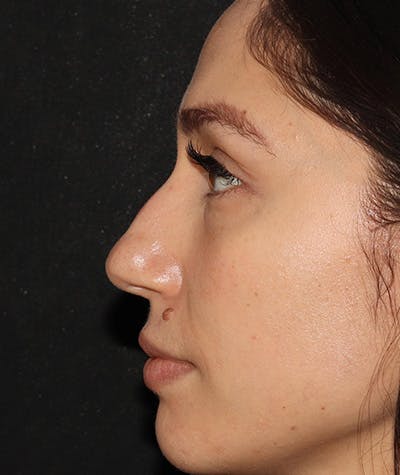 Liquid Rhinoplasty Before & After Gallery - Patient 157171660 - Image 1
