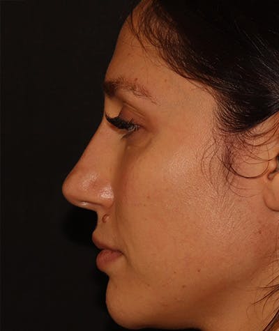 Liquid Rhinoplasty Before & After Gallery - Patient 157171660 - Image 2