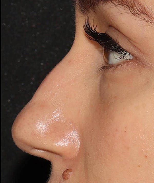 Liquid Rhinoplasty Before & After Gallery - Patient 157171660 - Image 9