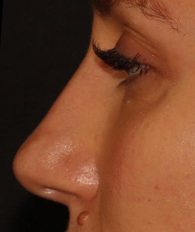 Liquid Rhinoplasty Before & After Gallery - Patient 157171660 - Image 10