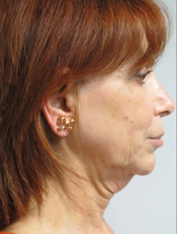 Facelift Before & After Gallery - Patient 121745296 - Image 1