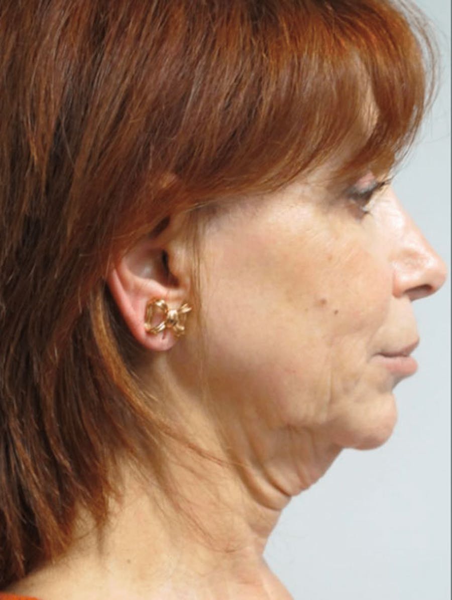 Facelift Before & After Gallery - Patient 121745296 - Image 1
