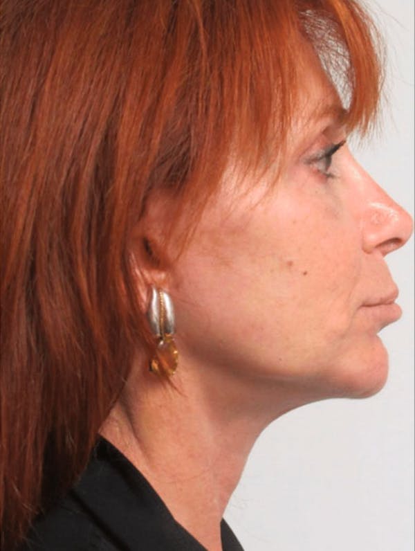 Facelift Before & After Gallery - Patient 121745296 - Image 2