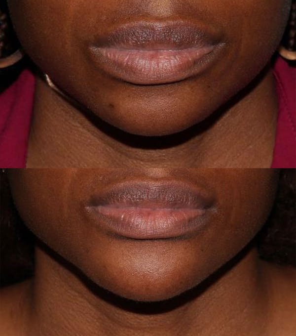 Chin Filler Before & After Gallery - Patient 159527015 - Image 2