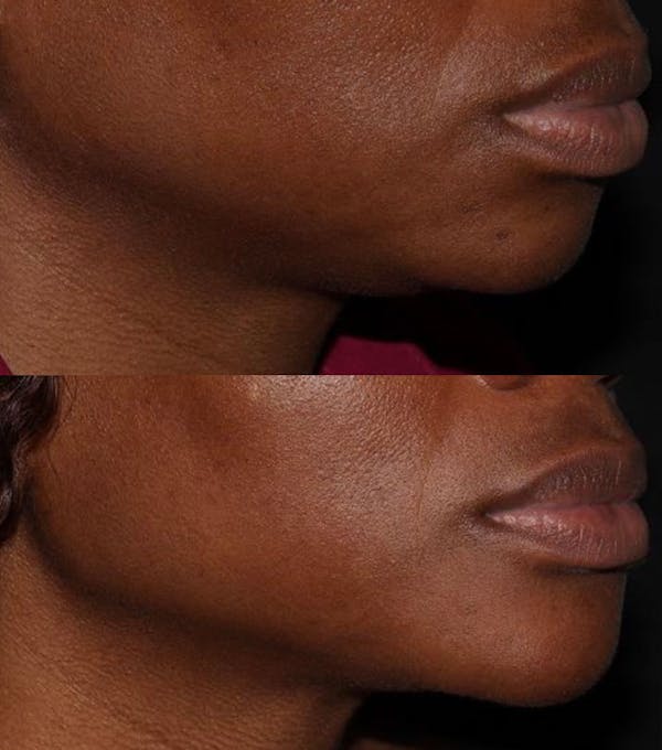 Chin Filler Before & After Gallery - Patient 159527015 - Image 1