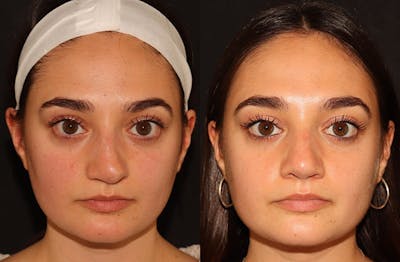 Rhinoplasty Before & After Gallery - Patient 160942425 - Image 2