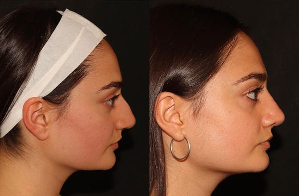Rhinoplasty Before & After Gallery - Patient 160942425 - Image 1