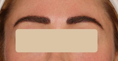Eyebrow Transplant Before & After Gallery - Patient 785944 - Image 2