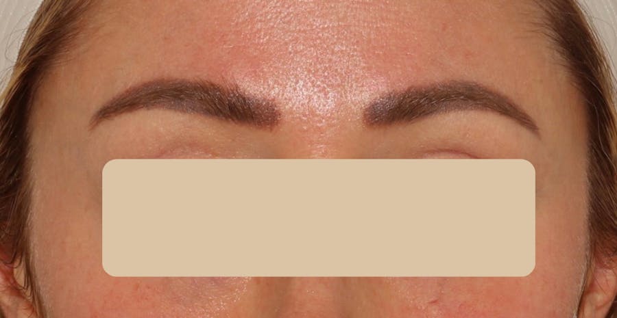 Eyebrow Transplant Before & After Gallery - Patient 785944 - Image 1