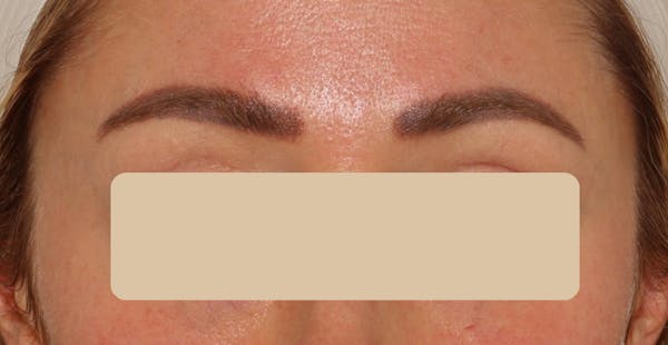 Eyebrow Transplant Before & After Gallery - Patient 785944 - Image 1