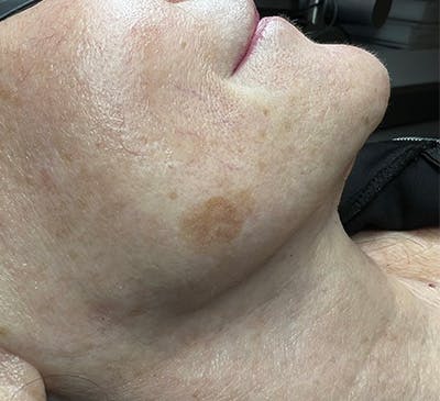 IPL Treatment Before & After Gallery - Patient 318122 - Image 1