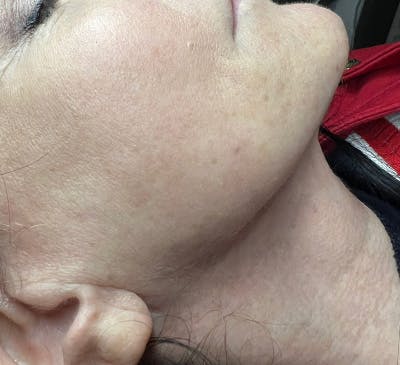 IPL Treatment Before & After Gallery - Patient 318122 - Image 2