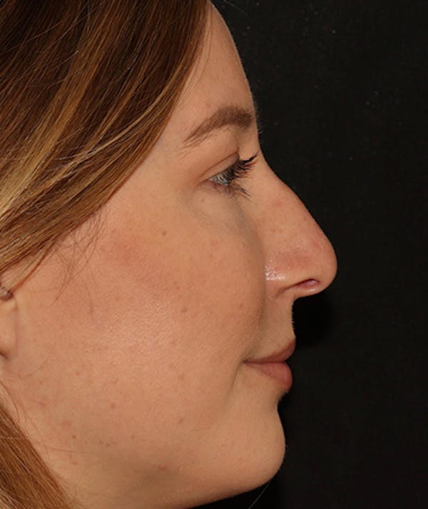 Liquid Rhinoplasty Before & After Gallery - Patient 405617 - Image 1